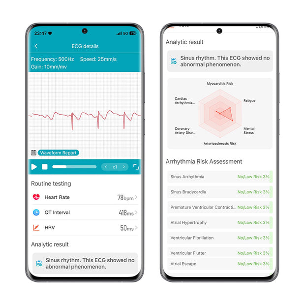 ECG Electrocardiogram